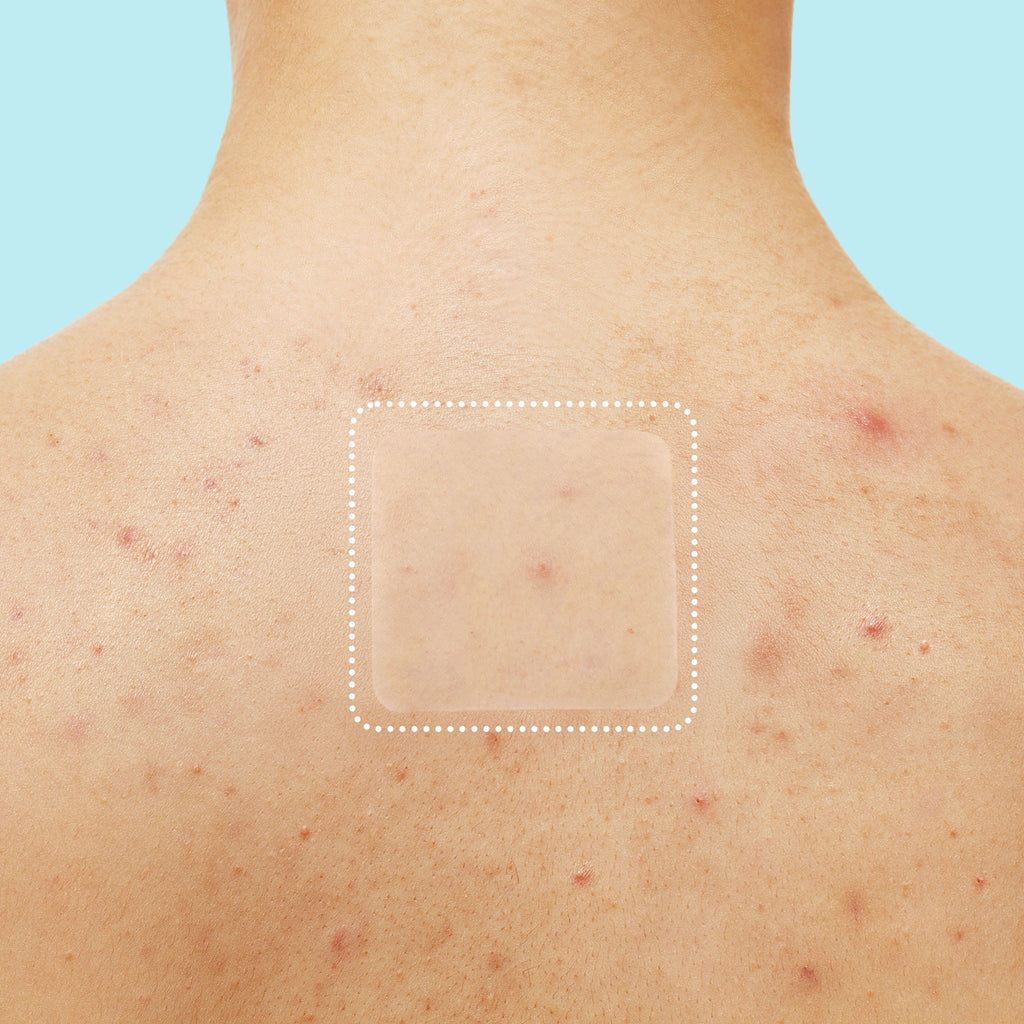 Miracle Patch XL Spot Control Cover I2