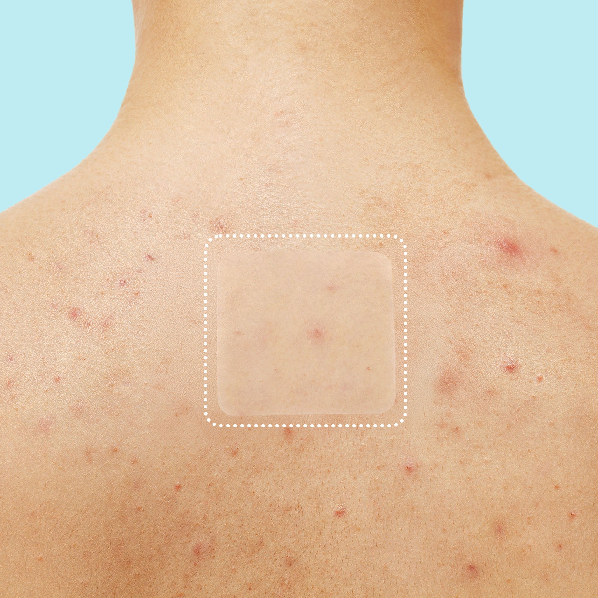 Miracle Patch XL Spot Control Cover I2